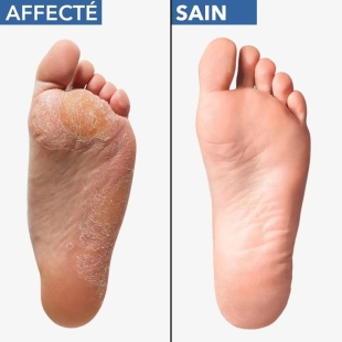ADDAX Mycoflash - Spray de Traitement pour Mycose des Pieds - 25ml